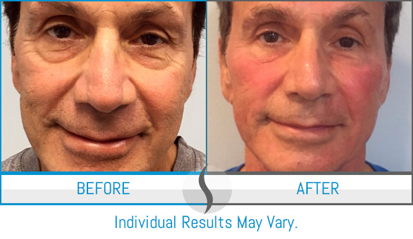 Before & After - Spa Blue Skin Care & Laser Center Orlando, FL Before & After - Spa Blue Skin Care & Laser Center Orlando, FL