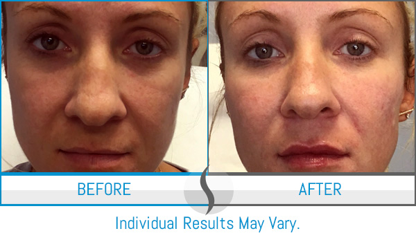 Before & After - Spa Blue Skin Care & Laser Center Orlando, FL Before & After - Spa Blue Skin Care & Laser Center Orlando, FL