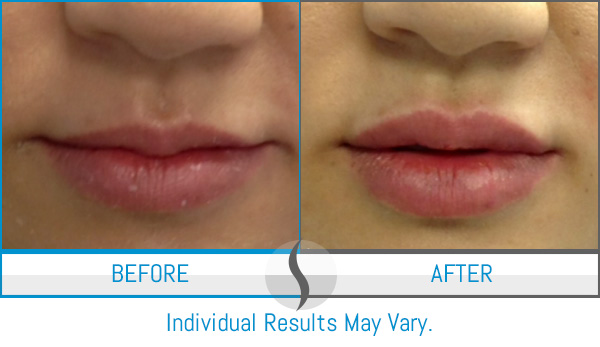 Before & After - Spa Blue Skin Care & Laser Center Orlando, FL Before & After - Spa Blue Skin Care & Laser Center Orlando, FL
