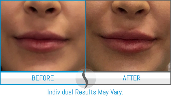 Before & After - Spa Blue Skin Care & Laser Center Orlando, FL Before & After - Spa Blue Skin Care & Laser Center Orlando, FL