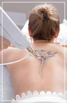 Laser Tattoo Removal - Spa Blue Skin Care & Laser Center in Orlando, FL