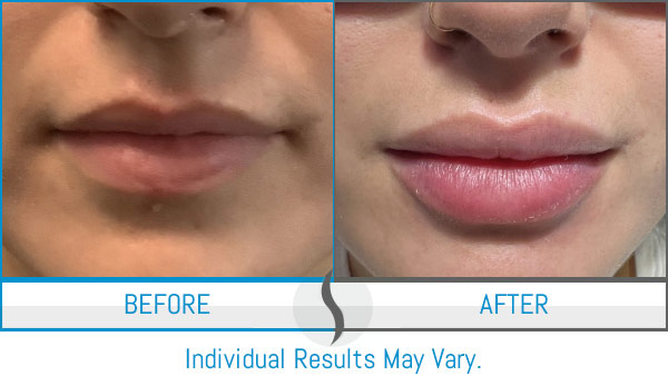 Before & After - Spa Blue Skin Care & Laser Center Orlando, FL