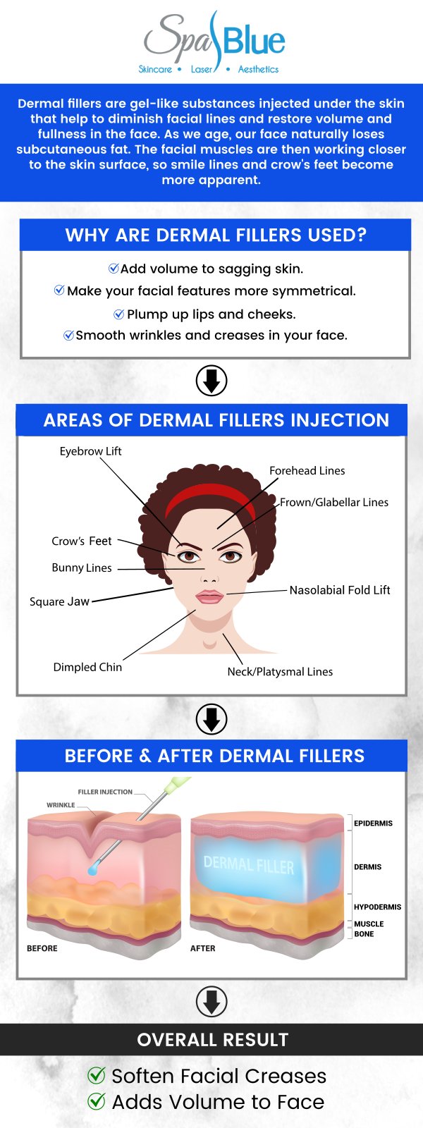 If you are looking for a treatment that can remove dermal fillers, look no further! At Spa Blue, Janet Beres, PA-C offers Vitrase, a painless & effective solution that corrects problems with dermal fillers such as Juvederm®, Restylane®, & more. For more information, contact us today or request an appointment online. Our medical spa is located at 7565 W Sand Lake Rd, Orlando, FL 32819.