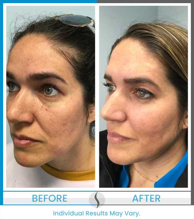 Microneedling Before and After at Spa Blue in Orlando FL