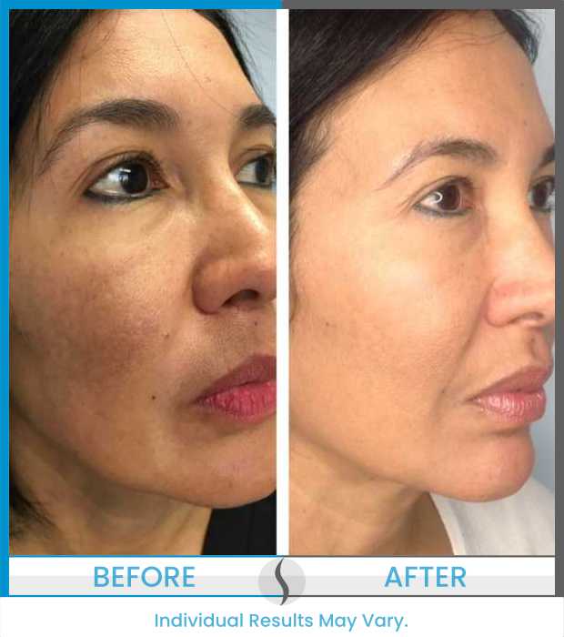 Microneedling Before and After at Spa Blue in Orlando FL