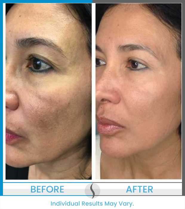 Microneedling Before and After at Spa Blue in Orlando FL