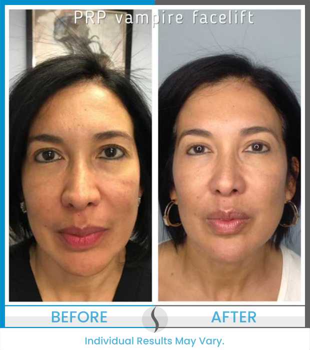 Microneedling Before and After at Spa Blue in Orlando FL