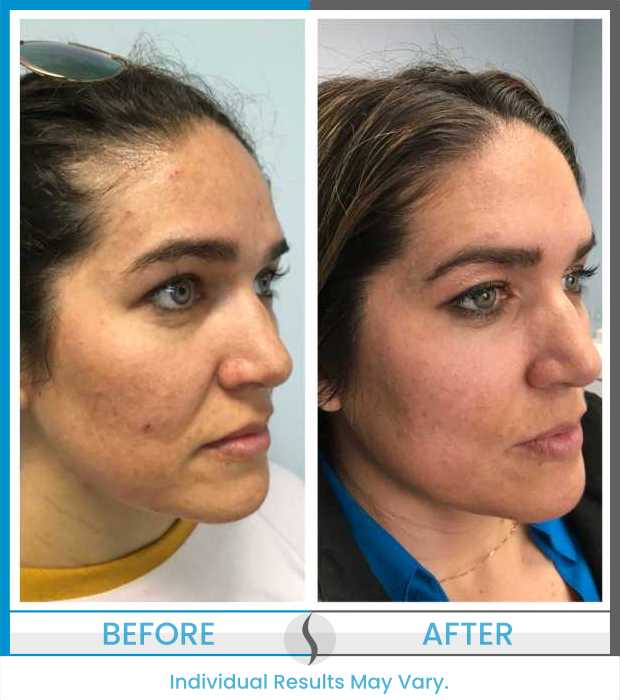 Microneedling Before and After at Spa Blue in Orlando FL
