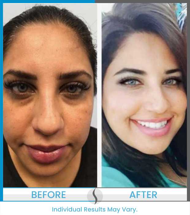 Microneedling Before and After at Spa Blue in Orlando FL
