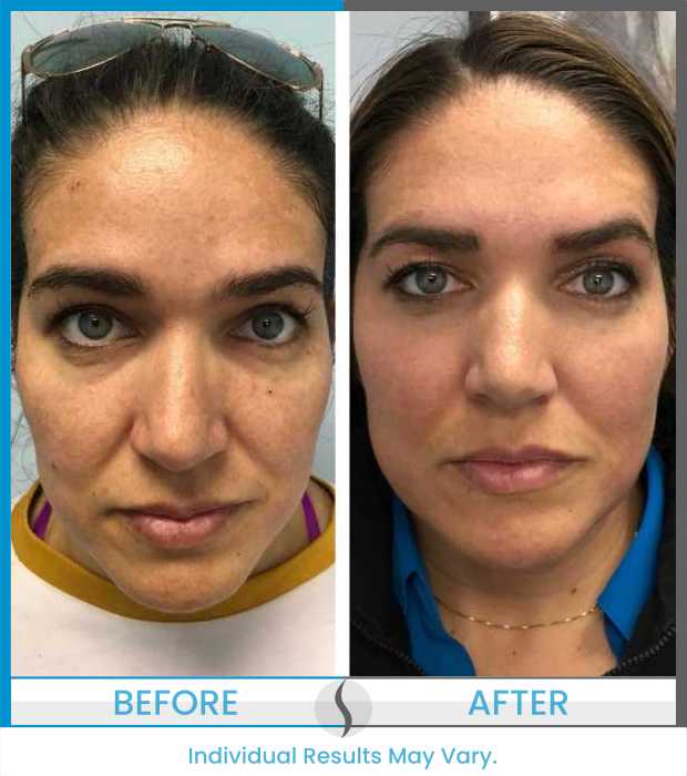 Microneedling Before and After at Spa Blue in Orlando FL