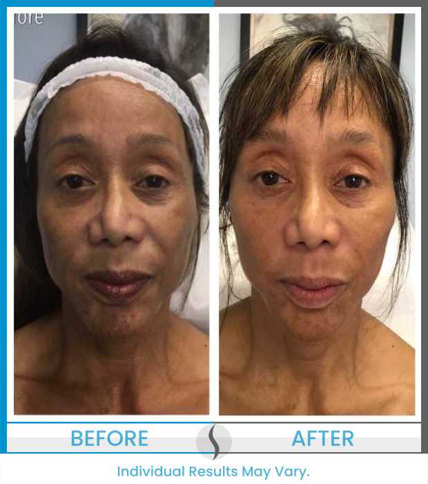 Microneedling Before and After at Spa Blue in Orlando FL