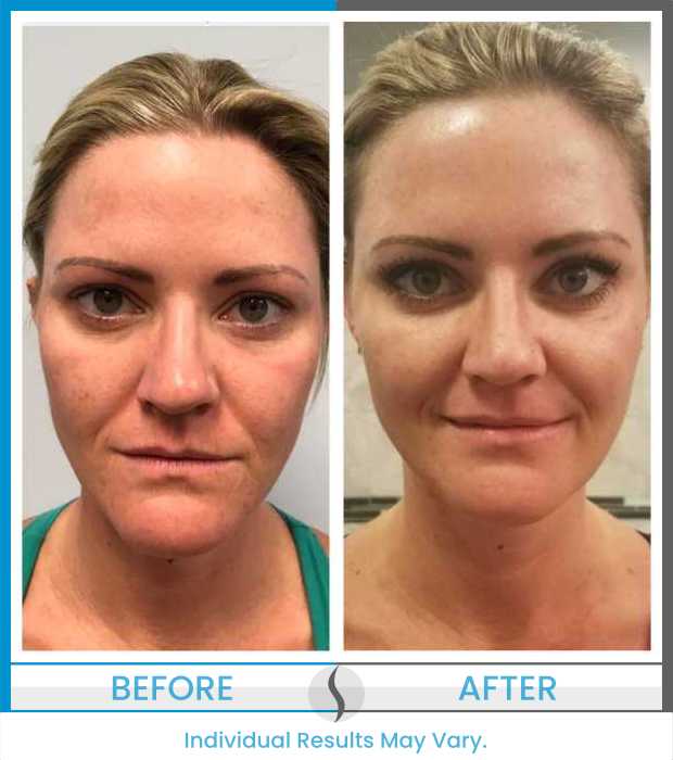 Microneedling Before and After at Spa Blue in Orlando FL