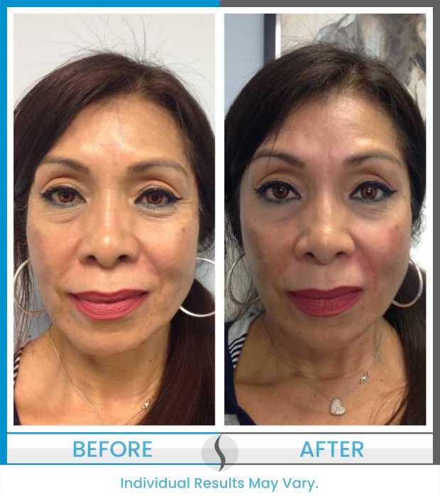 Microneedling Before and After at Spa Blue in Orlando FL