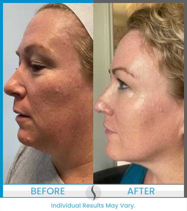 Microneedling Before and After at Spa Blue in Orlando FL