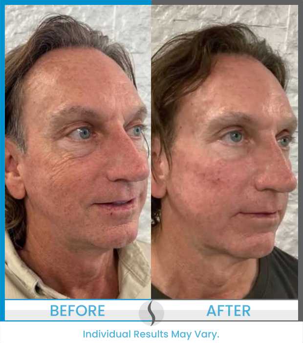 Microneedling Before and After at Spa Blue in Orlando FL
