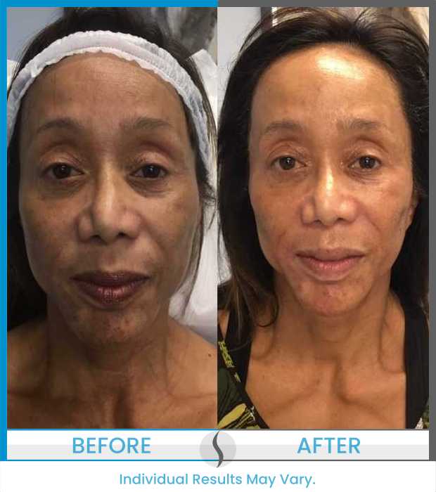 Microneedling Before and After at Spa Blue in Orlando FL