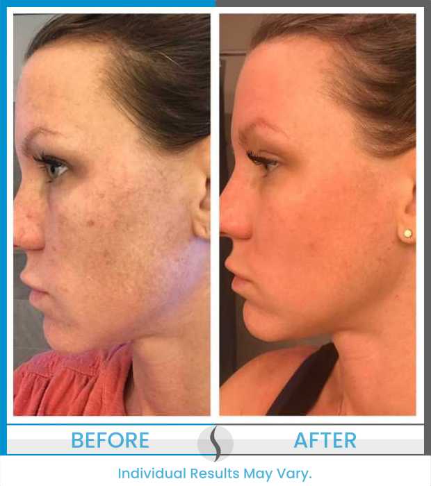 Microneedling Before and After at Spa Blue in Orlando FL