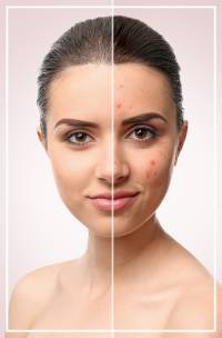 Scar Treatments  - Spa Blue Skin Care & Laser Center in Orlando, FL 